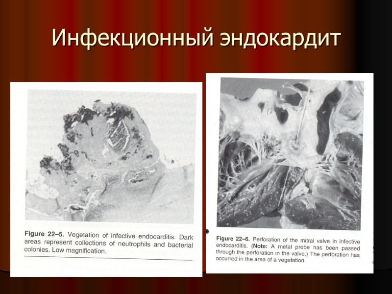 Инфекционный эндокардит